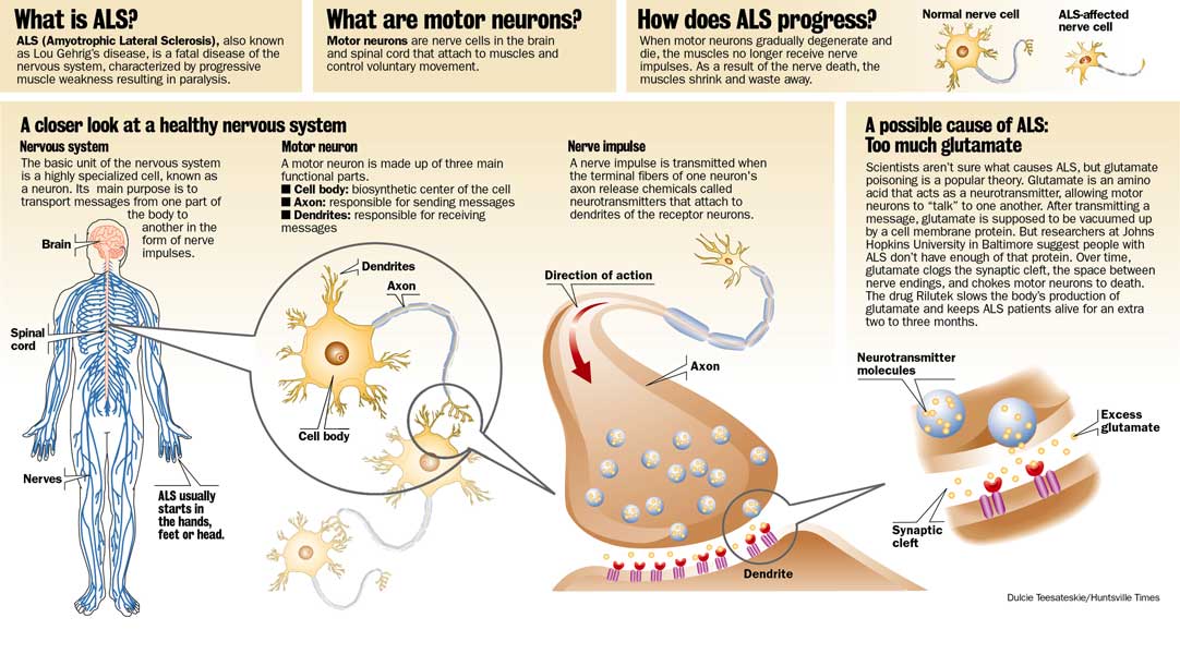 Motor neuron disease als amyotrophic lateral sclerosis